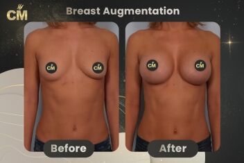 Breast Augmentation Before After-1