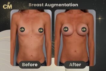 Breast Augmentation Before After
