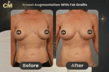 Breast Augmentation With Fat Grafts Before After-2