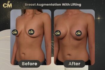 Breast Augmentation With Lift Before After-1