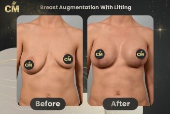 Breast Augmentation With Lift Before After-2
