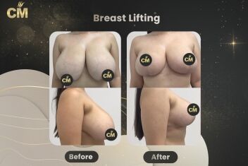 Breast Lift Before After-1