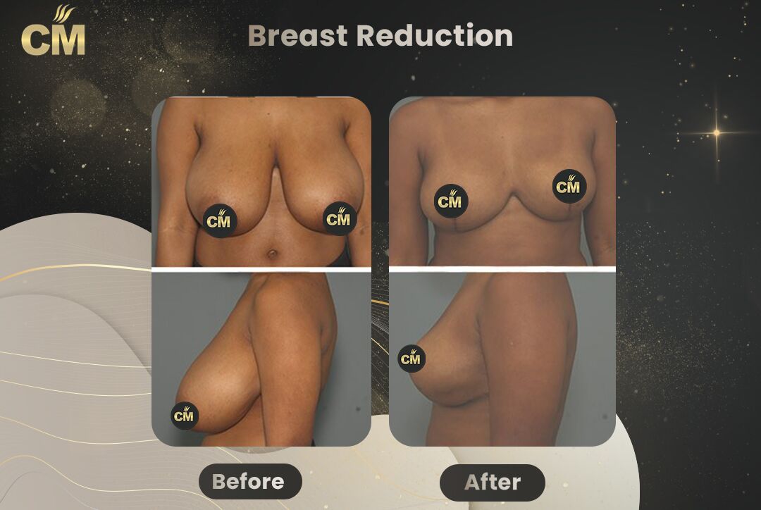 Breast Reduction Before After-1