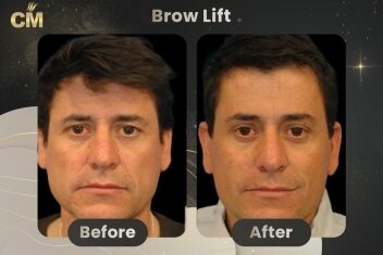 Brow Lift Before and After-1