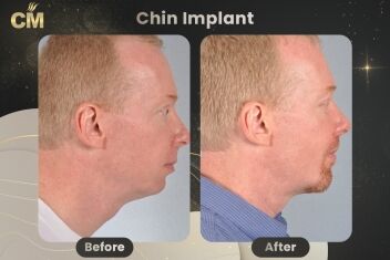 Chin Implant Before and After-1