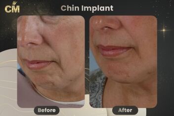 Chin Implant Before and After-2