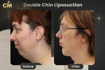 Double Chin Liposuction Before After-1