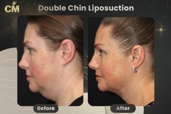 Double Chin Liposuction Before After-2