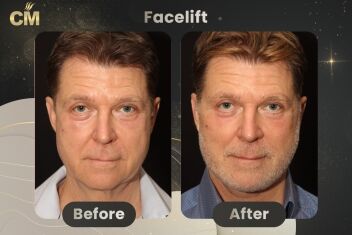 Facelift Before and After-2