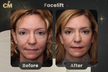 Facelift Before and After-1