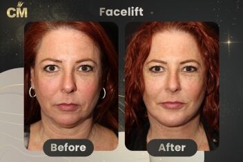 Facelift Before and After
