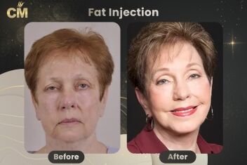 Fat Injection Before After in Turkey
Fat Injection Before After in Turkey
