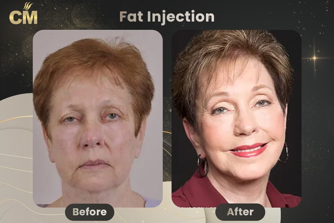 Fat Injection Before After in Turkey
Fat Injection Before After in Turkey