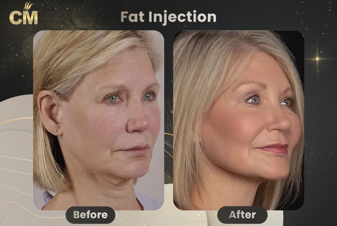 Fat Injection Before After in Turkey-1