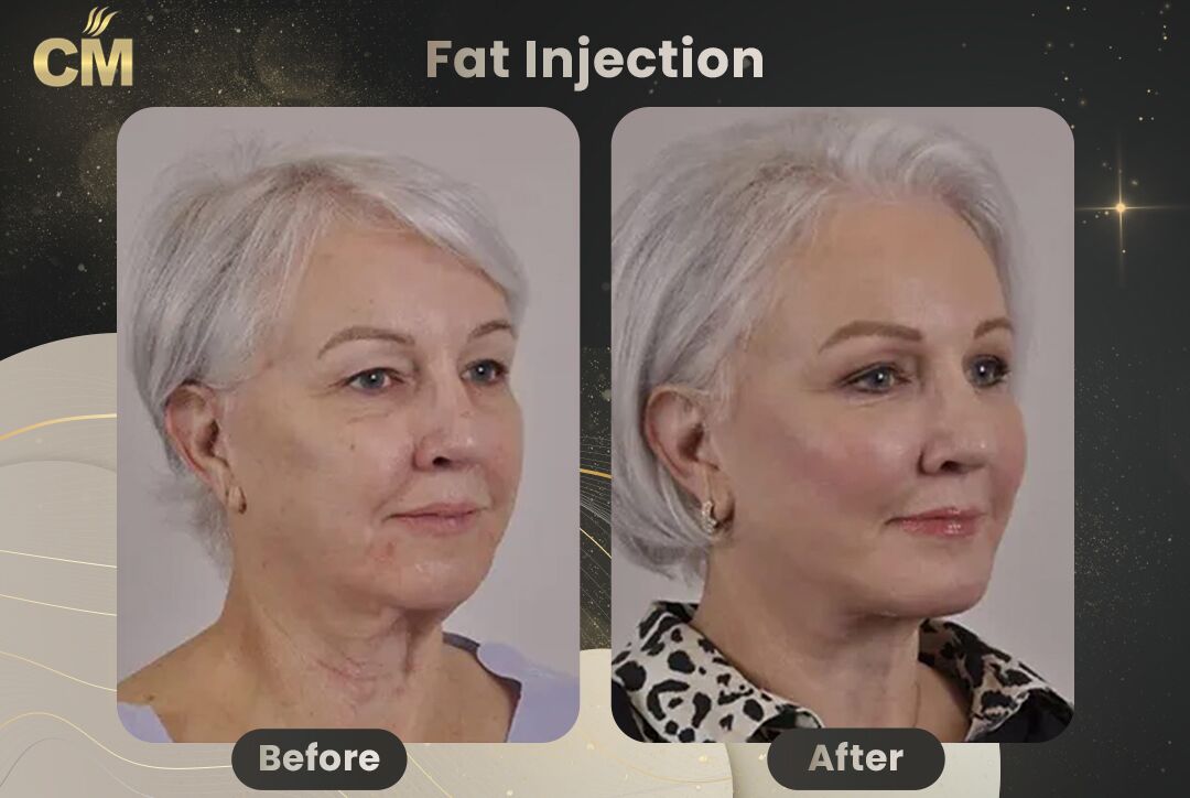 Fat Injection Before After in Turkey-2
