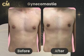 Gynecomastia Before After-1