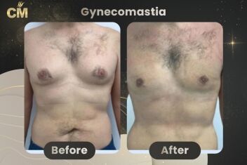 Gynecomastia Before After