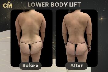 Body Lift Before and After-1