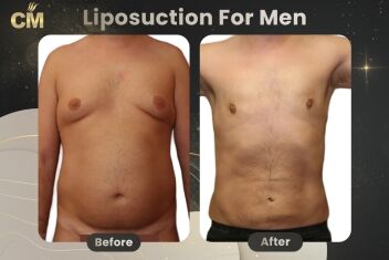 Liposuction For Men Before After