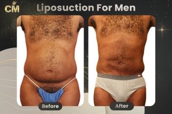 Liposuction For Men Before After-1