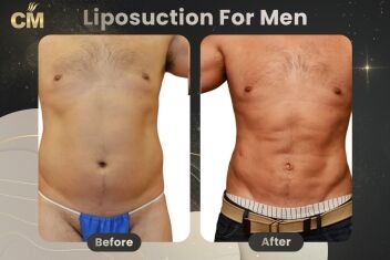 Liposuction For Men Before After-2