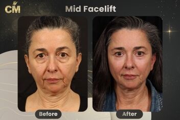 Mid Facelift Before and After