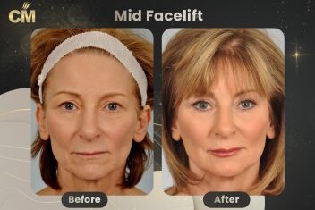 Mid Facelift Before and After-2