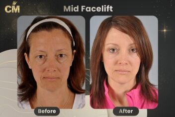 Mid Facelift Before and After-1