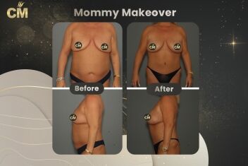 Mommy Makeover Vorher-Nachher-1