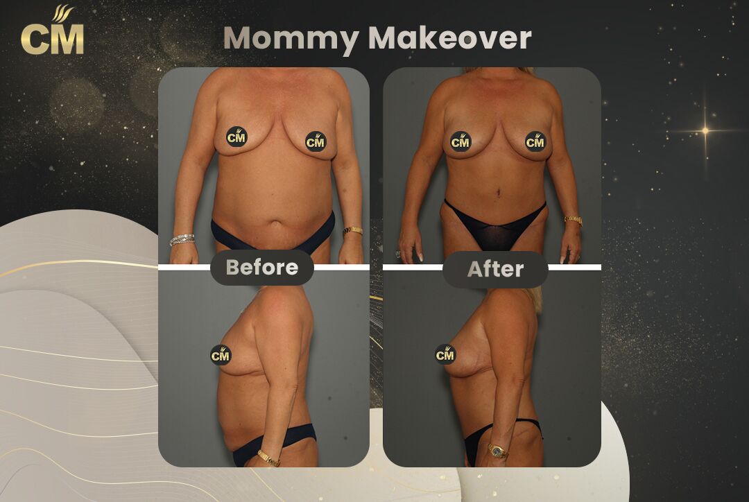 Mommy makeover before and after comparison showing body contour changes