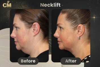 Neck Lift Before and After in Turkey