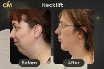 Neck Lift Before and After in Turkey-2