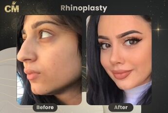 Rhinoplasty Before and After in Turkey-1