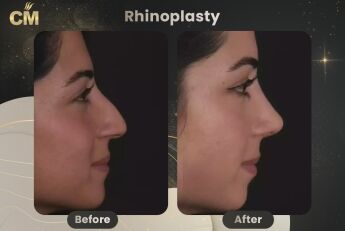 Rhinoplasty Before and After in Turkey-2