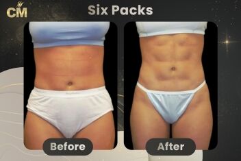 Six Packs Before After-1