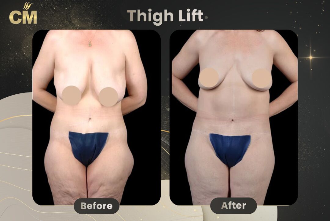 Thigh Lift Before After