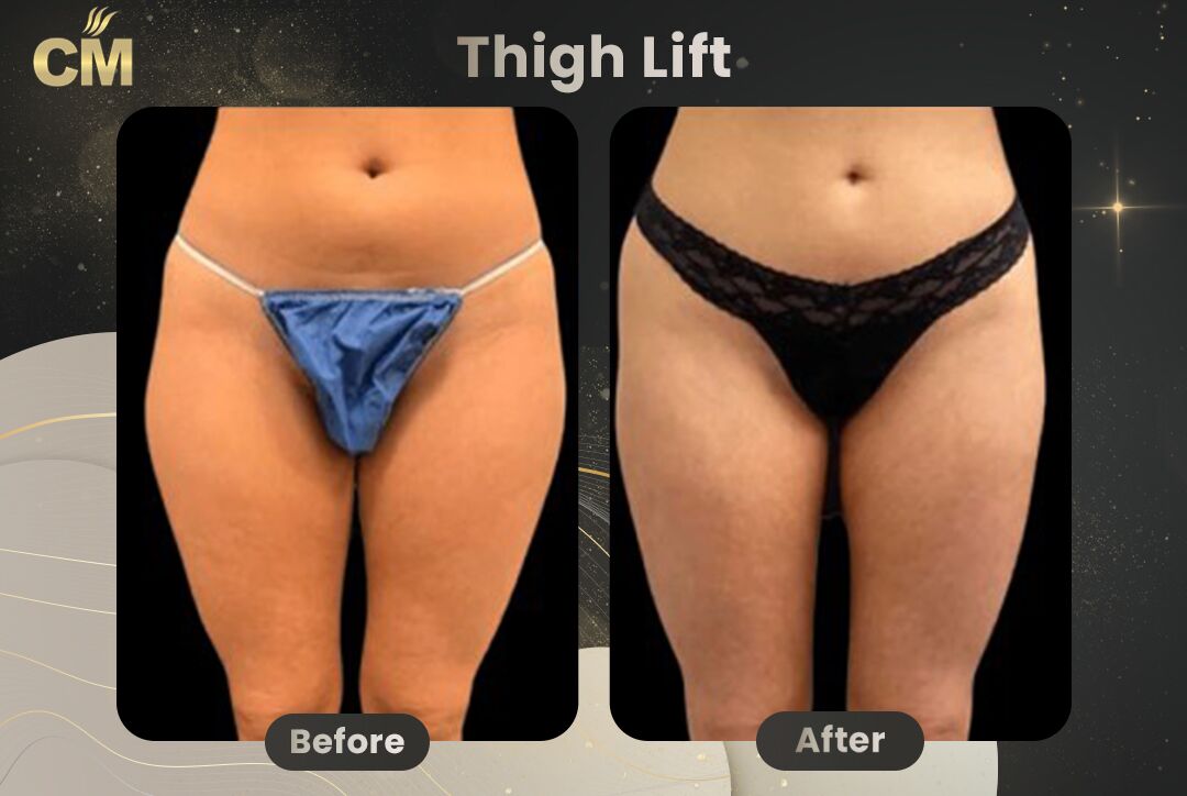 Thigh Lift Before After-1