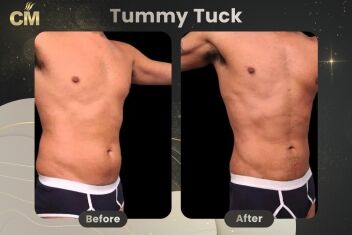 Tummy Tuck For Men Before After