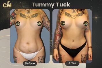 Bauchdeckenstraffung vorher und nachher-2