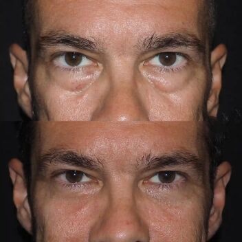 Blepharoplasty Before and After in Turkey-2