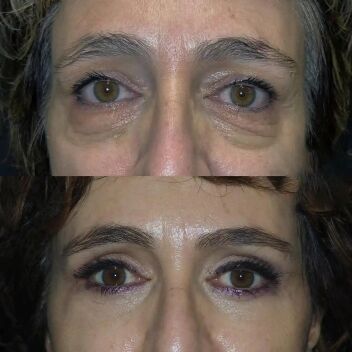 Blepharoplasty Before and After in Turkey-1