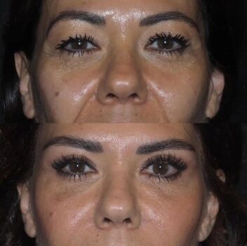 Blepharoplasty Before and After in Turkey