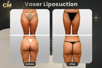 Vaser Liposuction Before and After