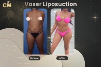 Vaser Liposuction Before and After-1