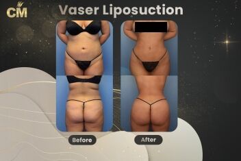 Vaser Liposuction Before and After-2