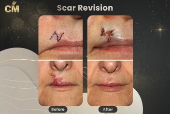 Scar Revision Before After-2