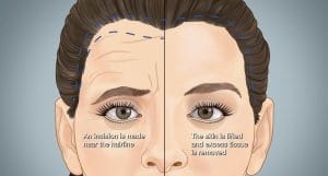 Lifting De Cejas En Turquía