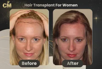 Hair Transplant For Women Before After in Turkey