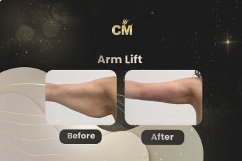 Arm Lift Before After