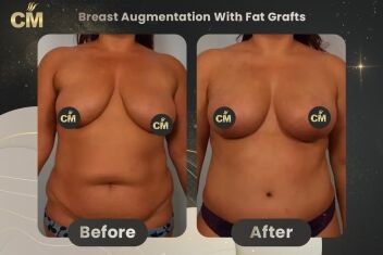 Breast Augmentation With Fat Grafts Before After-1